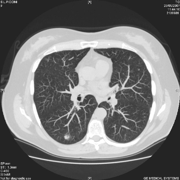 CT thorax partially solid nodule 8mm diameter