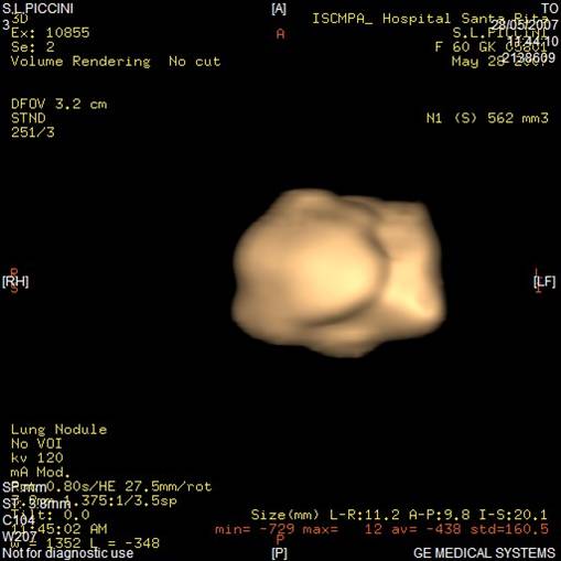 CT thorax, volume rendering 562 mm3