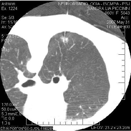 CT thorax, Fine needle insertion