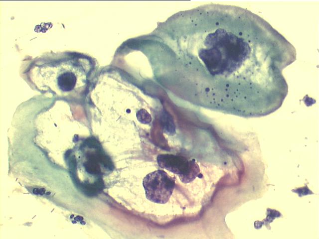 Koilocytes high power view of previous image 500x Pap staining