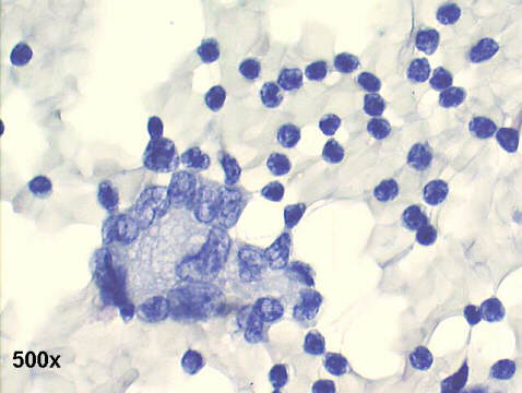500x Papanicolaou staining, 95% of cells are normal looking lymphocytes, and a Langhans type of histiocyte