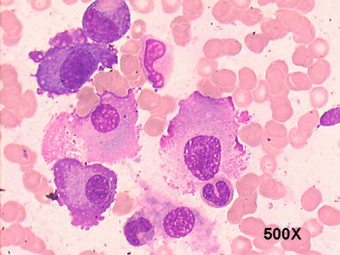 Bone marrow aspirate - Flame cells - MGG stain