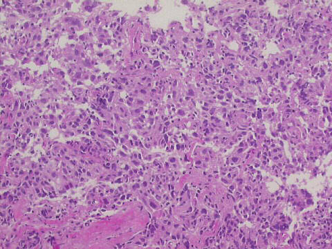 100x HE staining, core biopsy