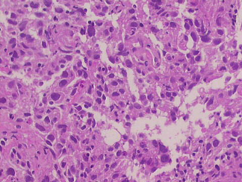 200x HE staining, core biopsy