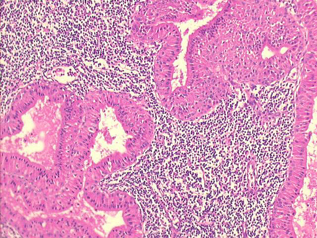Warthins tumor (adenolymphoma), 100x H&E staining, oncocytic cell lining of spaces, lymphocytic  stroma