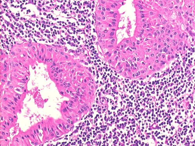 Warthin�s tumor (adenolymphoma), 200x H&E staining, detail view of oncocytic cells and lymphocytes in the stroma