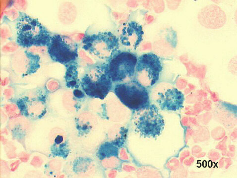 Hemosiderin staining, many siderophages