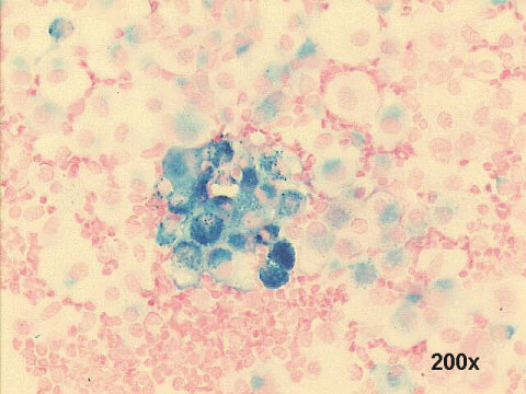 Hemosiderin staining