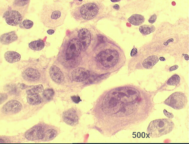 Only after careful scrutiny we found some groups of cells with epithelial appearance, like this one  500x Pap staining