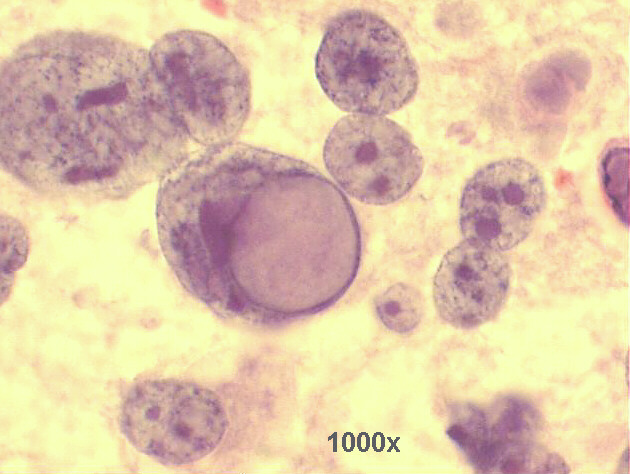 Detail view of the anaplastic cell with large intranuclear vacuole giving the cell a signet ring appearance  1,000x Pap staining