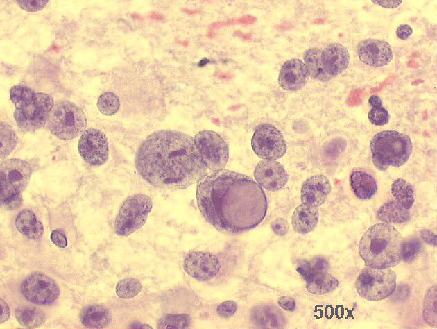Anaplastic cell with large intranuclear vacuole giving the cell a signet ring appearance 500x Pap staining