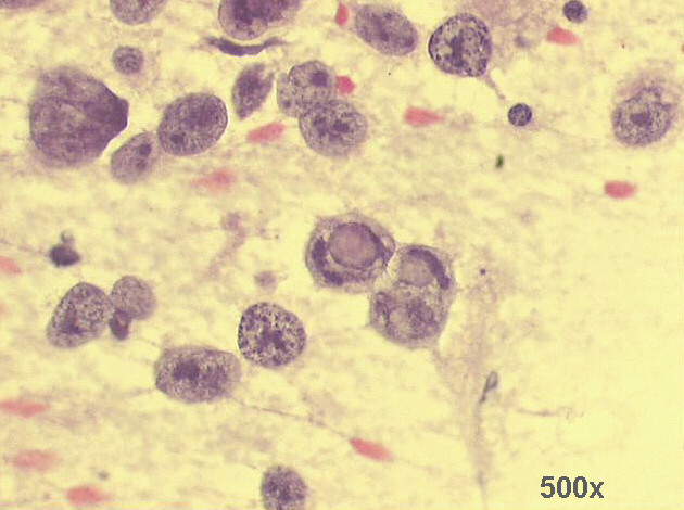 Several anaplastic cells, some of them with intranuclear vacuoles 500x Pap staining