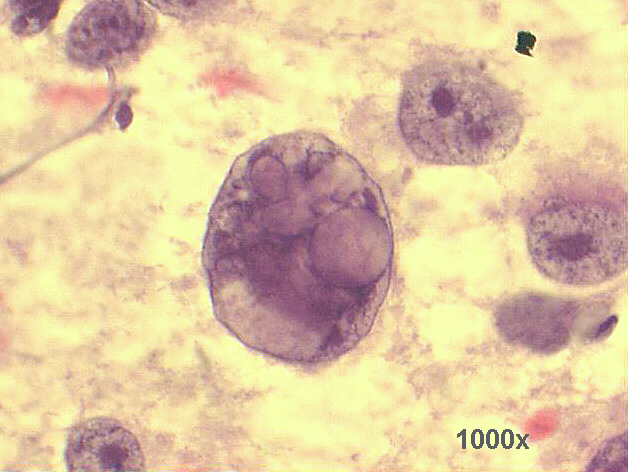 Huge naked nucleus with intranuclear vacuoles 1,000x Pap staining