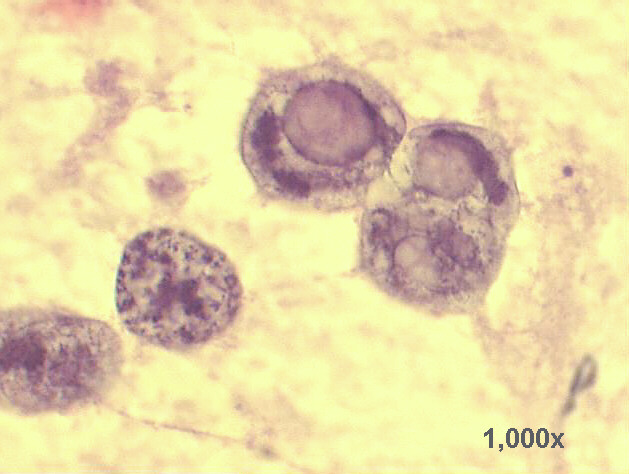 Detail view of the two cells with intranuclear vacuoles 1,000x Pap staining