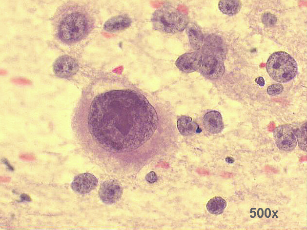 Quite large anaplastic cell with huge nucleolus 500x Pap staining