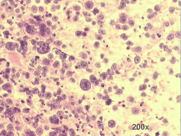 Medium power view: abundant cellularity of poorly differentiated malignant neoplasia, with preponderance of isolated cells and naked nuclei 200x Pap staining