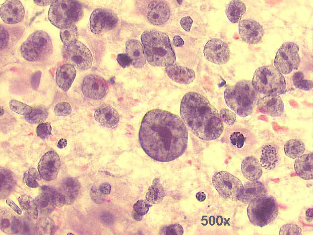 High power view: quite anaplastic malignant isolated cells with large nucleoli and coarse chromatin 500x Pap staining