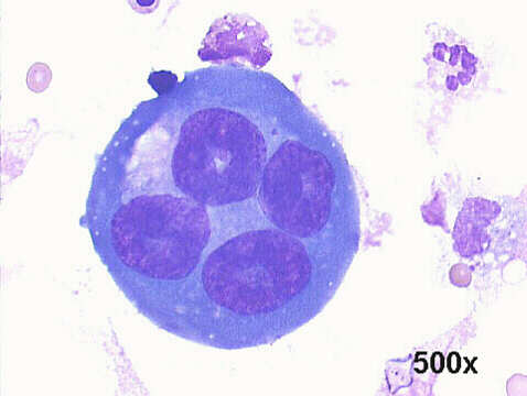 Pleural fluid, M-G-G staining