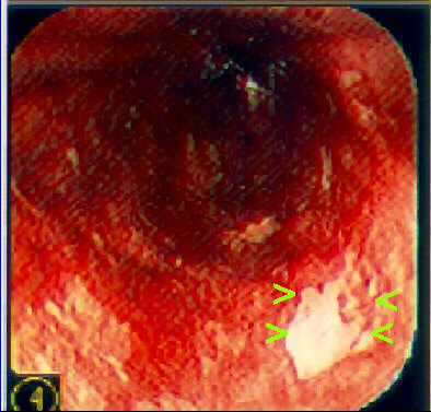 Lugol negative staining area at esophagoscopy
