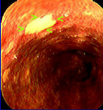 Lugol negative staining area at esophagoscopy