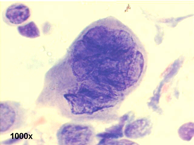 1000x M-G-G staining, high power view of above image