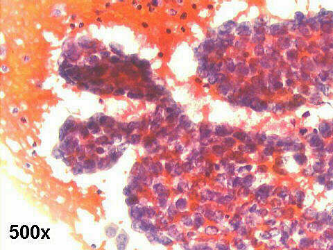 Muco-papillary adenocarcinoma, 500x Pap staining