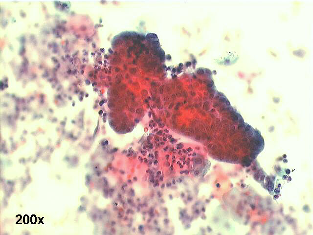 200x Papanicolaou staining