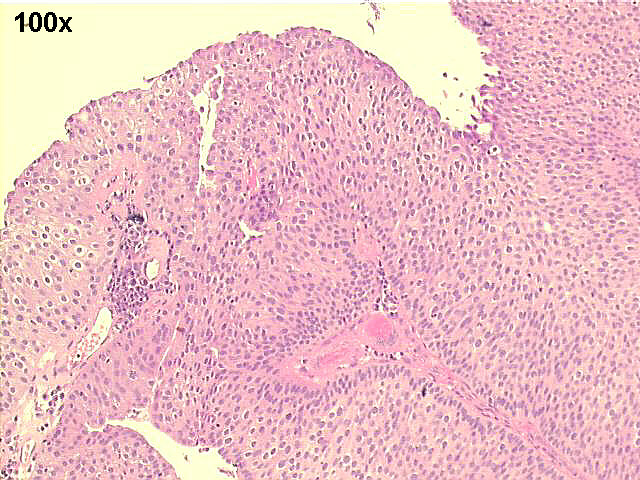 100x H&E staining, showing papillary urothelial carcinoma grade II~III