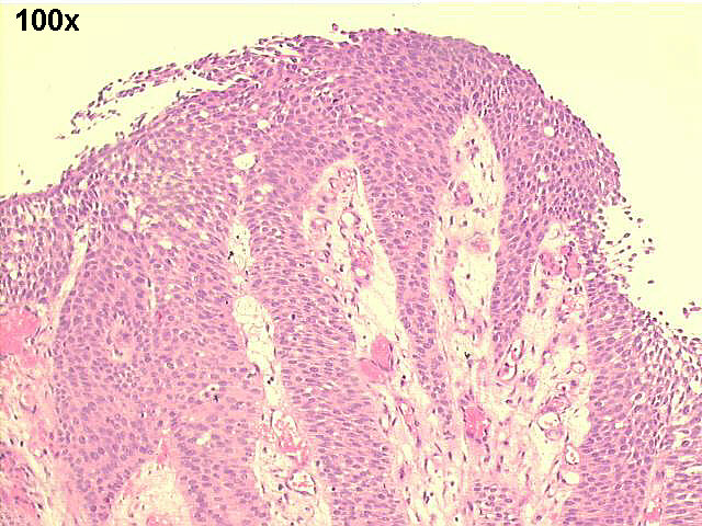 100x H&E staining, showing papillary urothelial carcinoma grade II~III