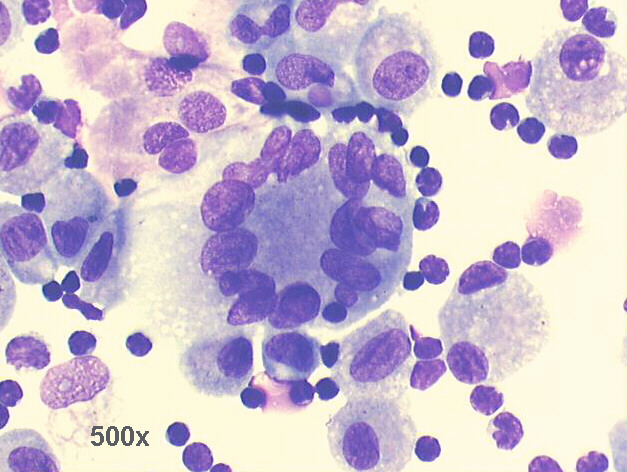 M-G-G staining  ~ Large Langhans histiocyte, monocytes and lymphocytes
