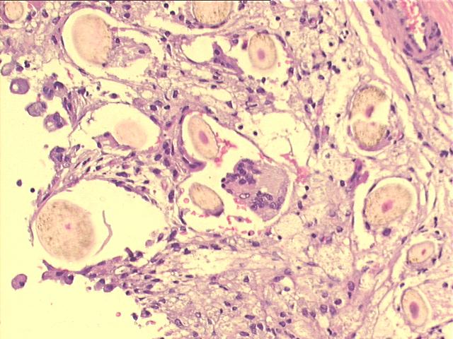 ovarian dermoid cyst200x H&E staining, cross secion of many hairs on the wall of the cyst, and a foreign body giant cell.