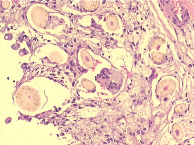 ovarian dermoid cyst200x H&E staining, cross secion of many hairs on the wall of the cyst, and a foreign body giant cell.