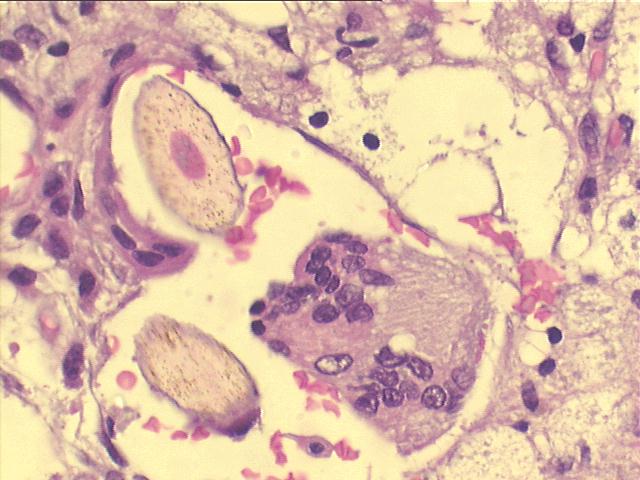 ovarian dermoid cyst 500x H&E staining, detail view showing the cross section of hairs, and of the foreign body giant cell.