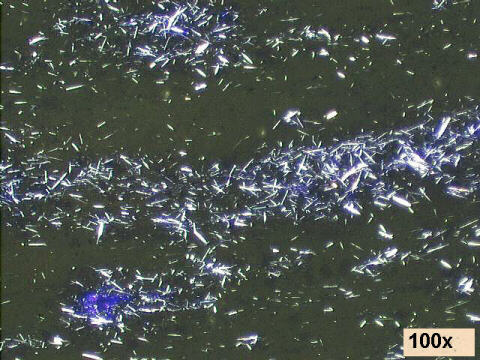 gout arthritis. 100x under polarized light: uric acid needle crystals