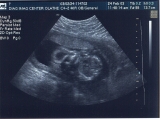 Ultrasound #2