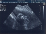 Ultrasound #3