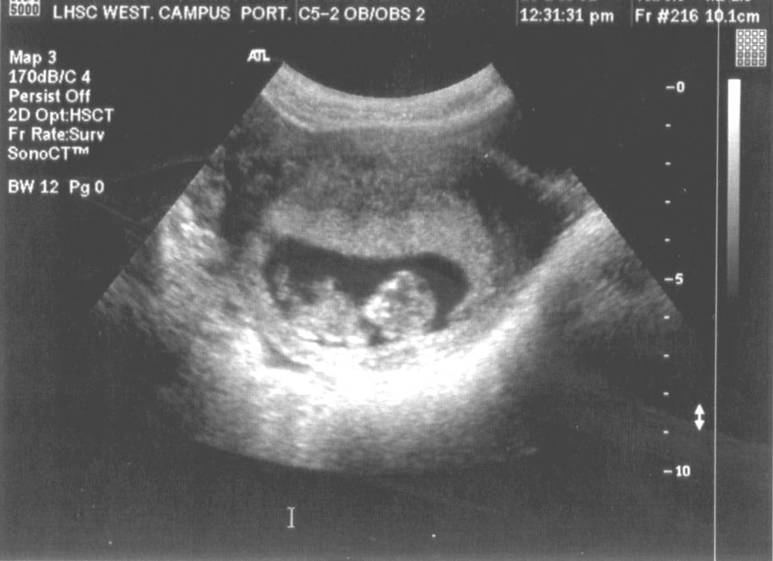 Baby @ 11w