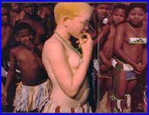 Albino child