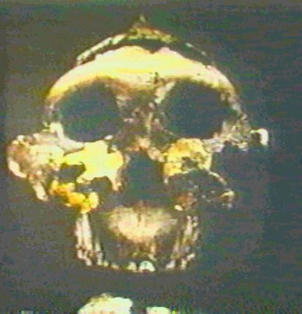 Australopithecus robustus