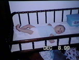 Rose's clubfoot