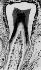 Hen's Tooth - Vestigial Dinosaur Tooth Dormant in Chick Genome