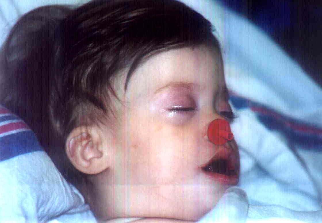 One hour after surgery