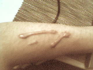 Close-up of scar on arm