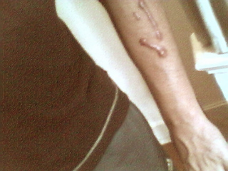 The not so close up of the scar on my arm