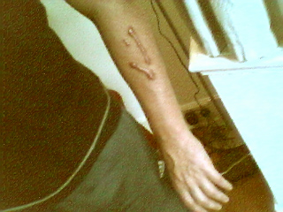 The definately not so close up of the scar on my arm