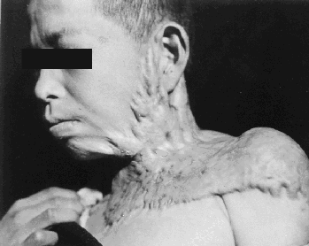 Keloid after an Atomic Bomb