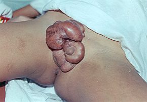 Keloid Scarring after Circumcision to Boy aged 6