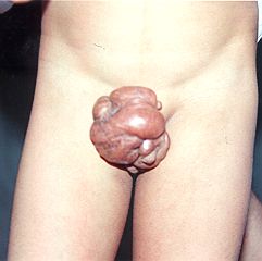 Keloid Scarring after Circumcision to Boy aged 6 (2)
