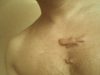 The not so close up of the scar on my chest