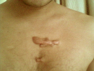 The definately not so close up of the scar on my chest